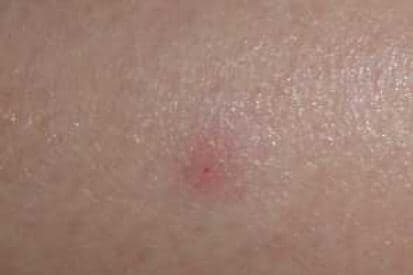 bed-bug-bites