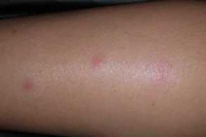 bed-bug-bites